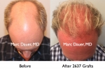 Before and After hair transplant photos