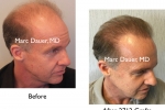 Before and after hair transplant photos