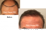 Hair Transplant Before and After Photos