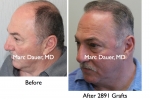 Hair Transplant before and after Pictures