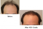 Hair restoration Results