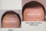 Before and After Hair Transplant Photos6