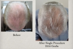 Before and after hair transplant pictures 6