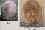 Hair Transplant Before After Photos Results 6