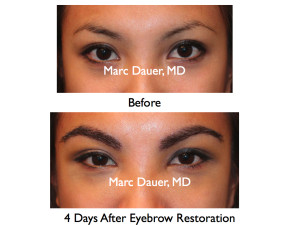 Here is a patient pre eyebrow transplant and 4 days after the eyebrow transplant procedure.