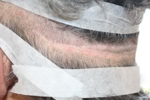 L hair transplant scar pre- revision