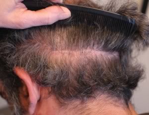 L Hair Transplant Scar Post Revision