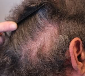 R Hair Transplant Scar Post Revision