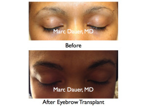 Eyebrow Transplant In African American Female patient