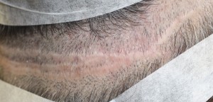 This is a photo of multiple strip scars created by another Hair Transplant surgeon.