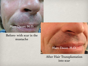 Here is a patient with a scar in his mustache who received transplanted hair grafts to cover the scar and enhance his mustache.