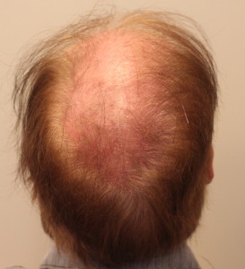 This is a patient who underwent a scalp reduction years ago. The resulting "slot deformity" in seen in the photo.