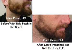 Beard Transplant via FUE