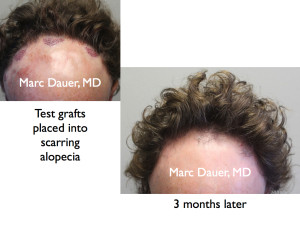 This is a patient with scarring alopecia who had test grafts placed into 3 different areas.