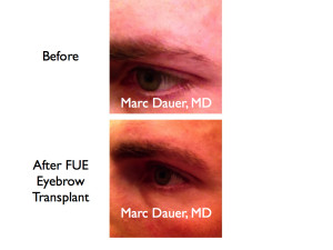 This is a male patient who had an eyebrow transplant with harvest via FUE.