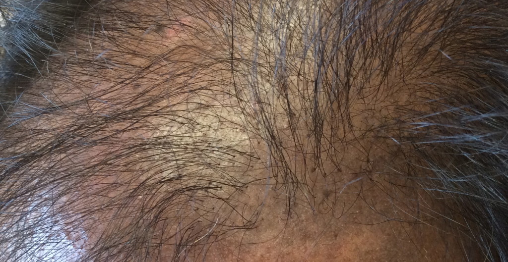This photo shows "pitting" from a previous hair transplant.