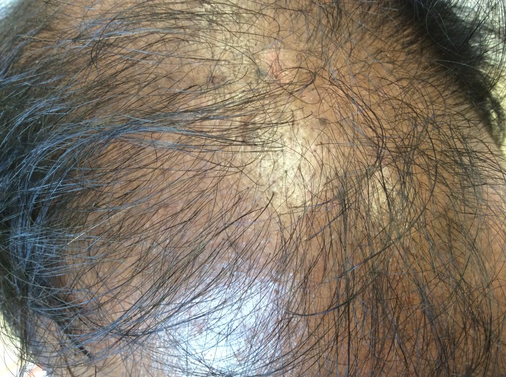 This is from the same patient the other side of the frontal scalp that does not show significant pitting.