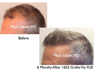 FUE Hair Transplant Results