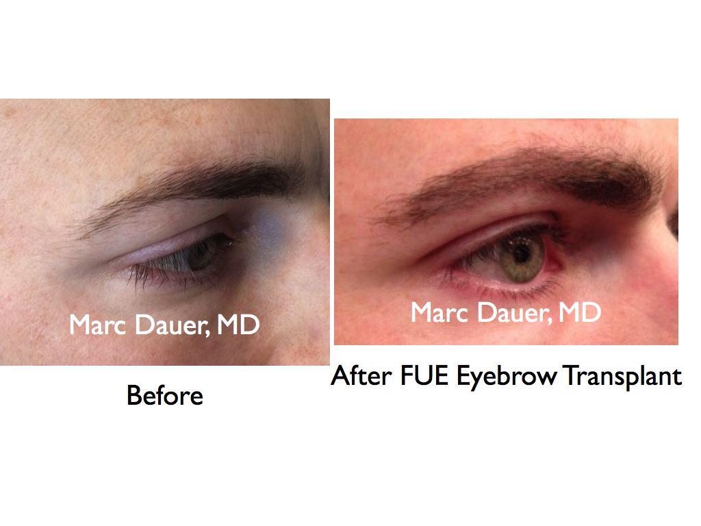 Eyebrow transplant utilizing grafts harvested via FUE.