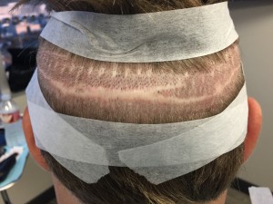 Showing the strip scar before revision.