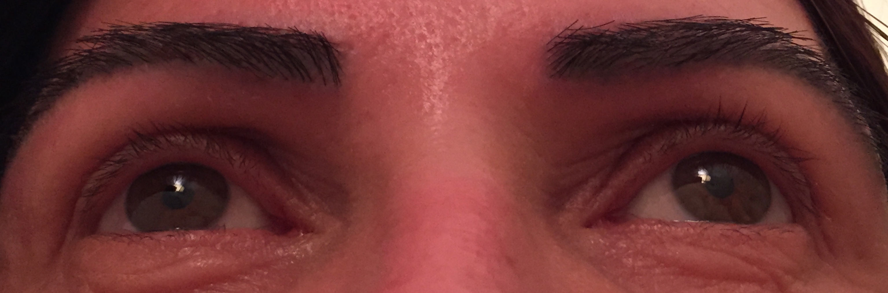 This is one week after approximately 300 grafts were placed in each eyebrow to correct a botched eyebrow transplant procedure.