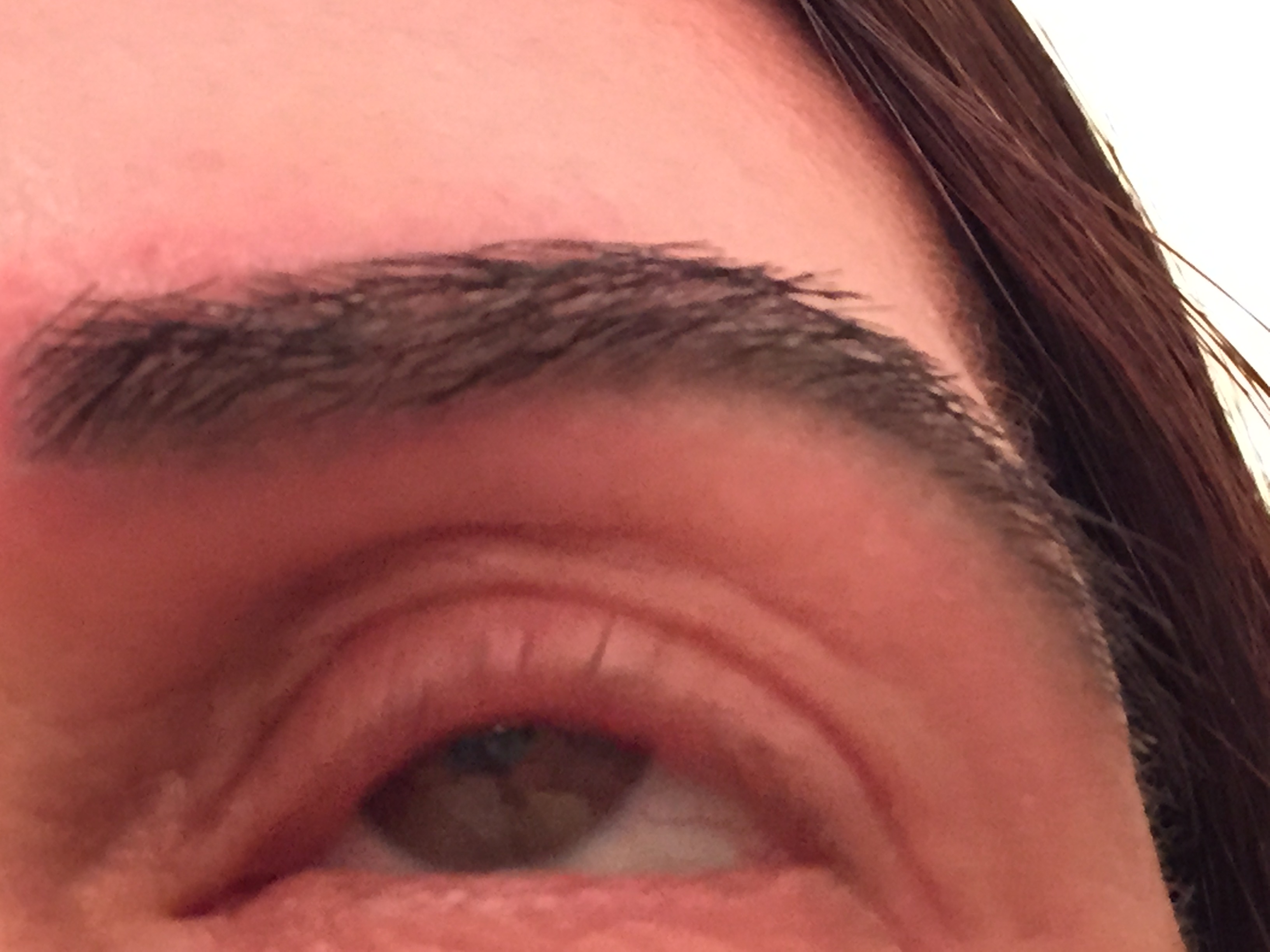 This is one week after approximately 300 grafts were placed in each eyebrow to correct a botched eyebrow transplant procedure.