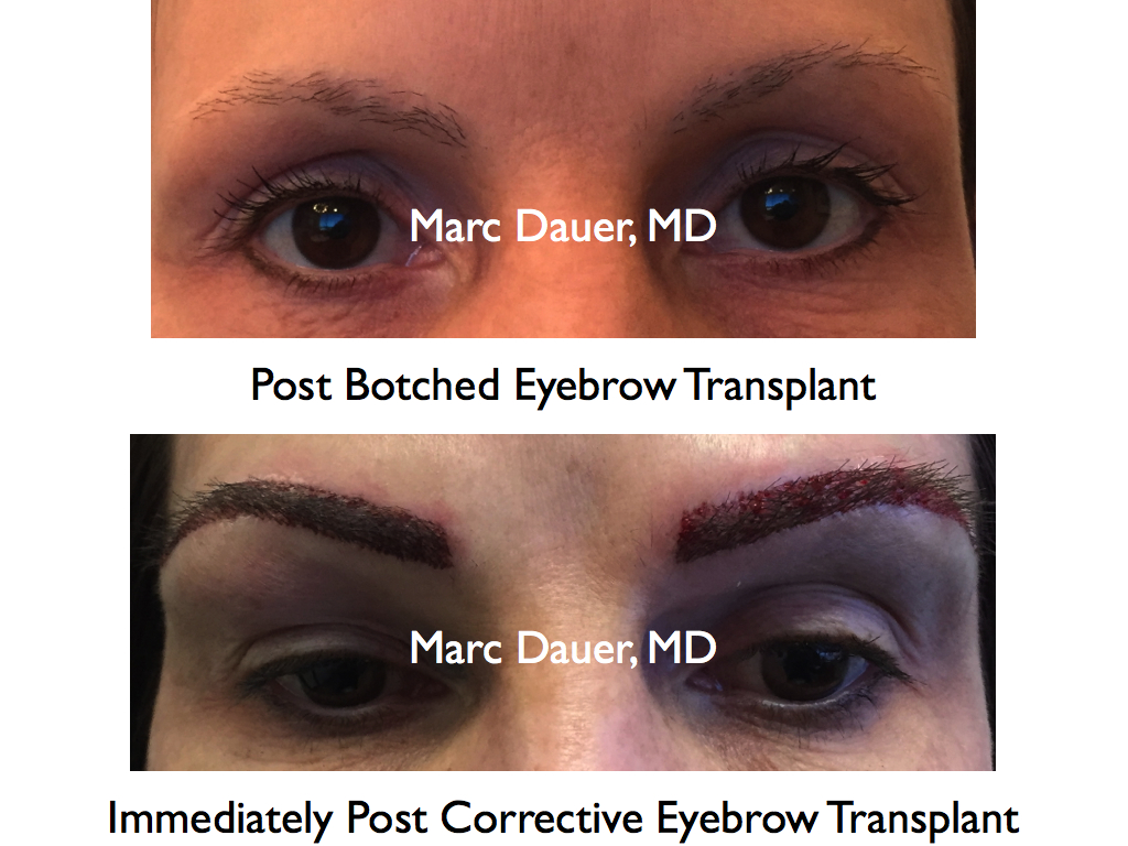 This is a patient who had a prior poor eyebrow transplant corrected with proper placement and density of hairs.