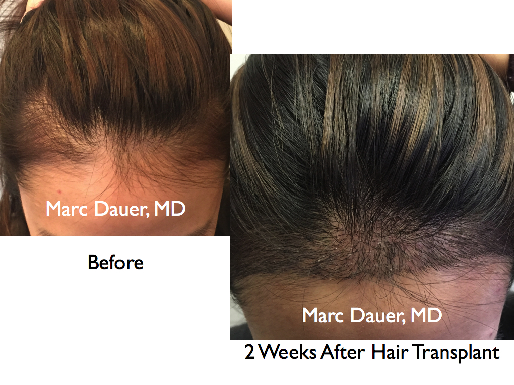 This is photos of a female patient who received a hair transplant to lower the hairline.