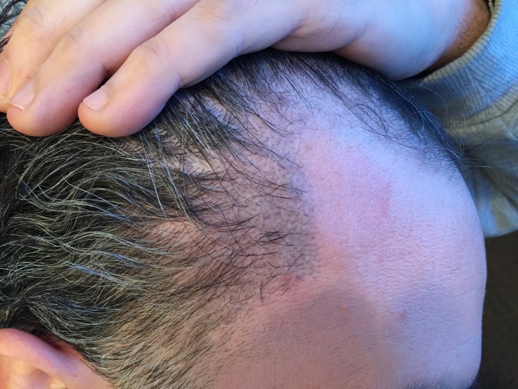 This is a failed FUE transplant into temporal peaks with subsequent scalp micro pigmentation.