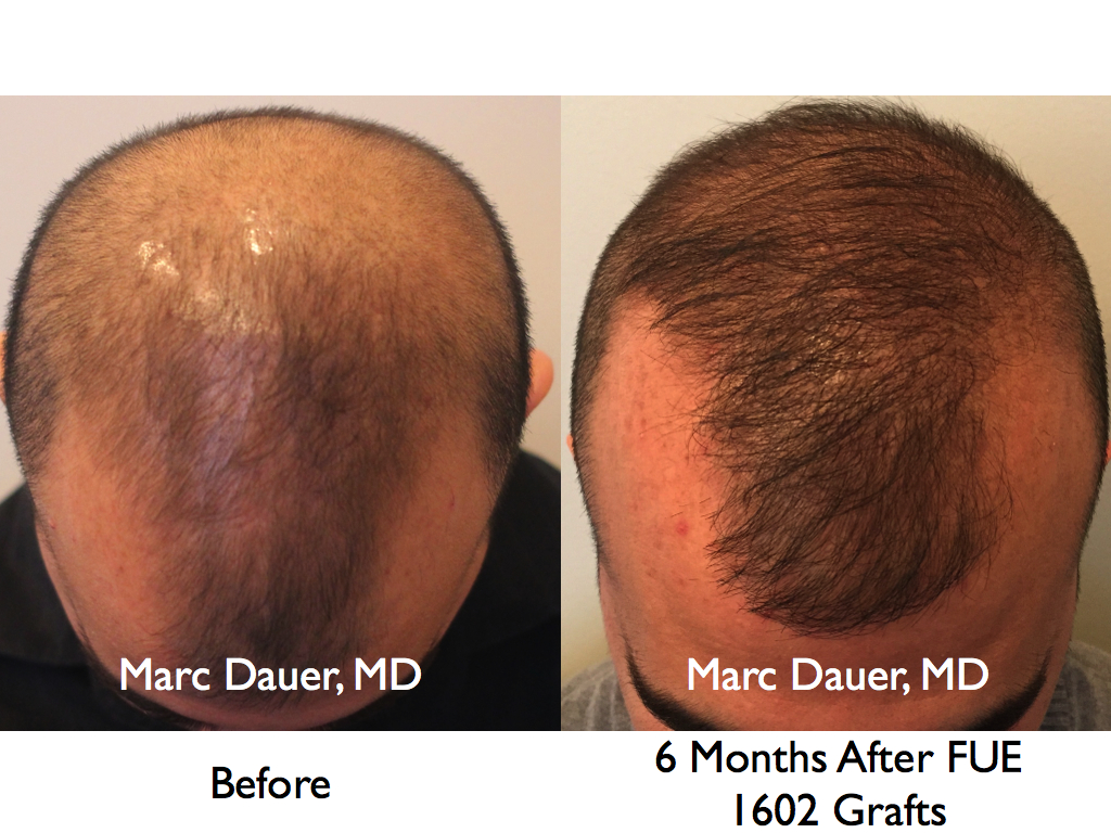 This is a patient who had an FUE transplant of 1602 grafts after 6 months.