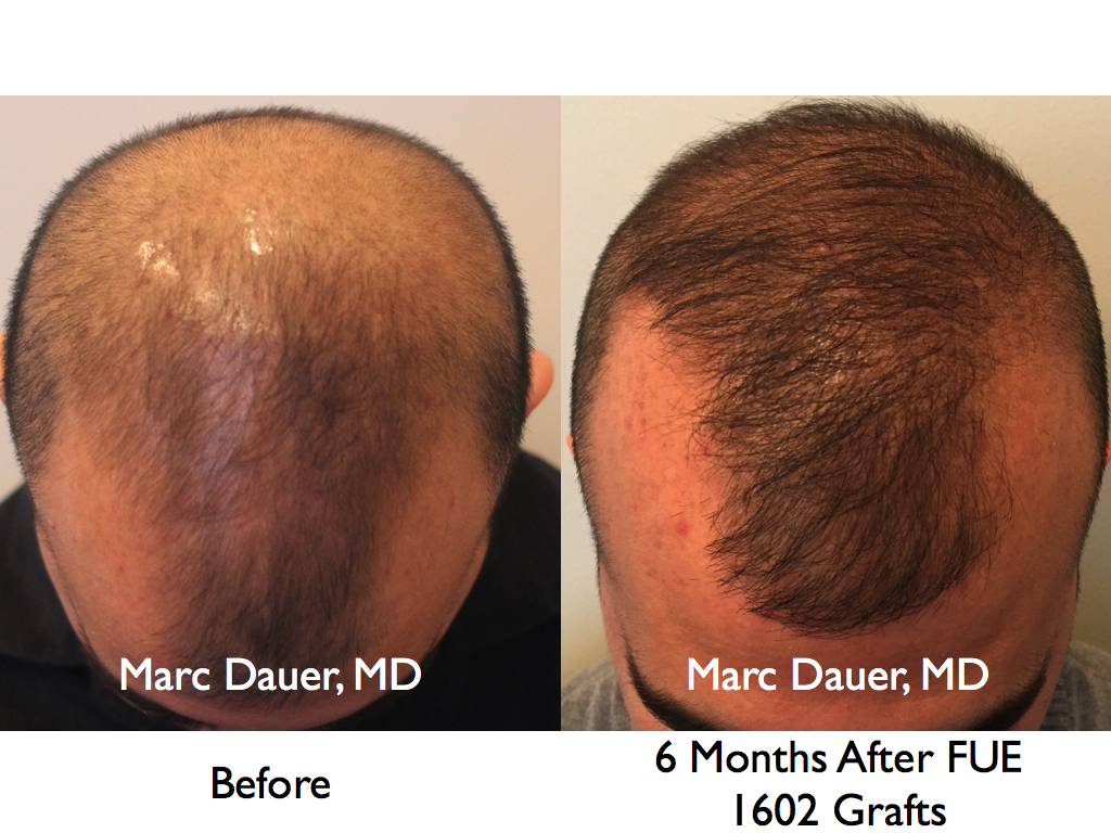 FUE Hair Transplant AT 6 Months Marc Dauer MD Hair Transplant Doctor 