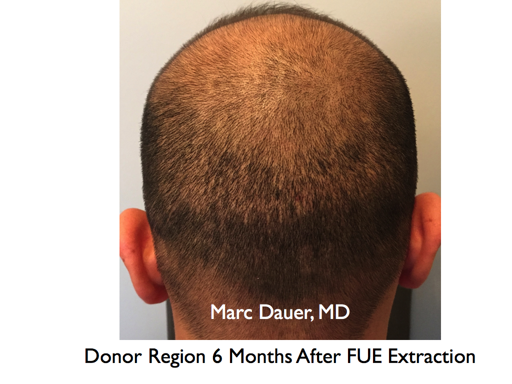 The donor region shown 6 months after 1602 Grafts harvested with a .9mm punch.