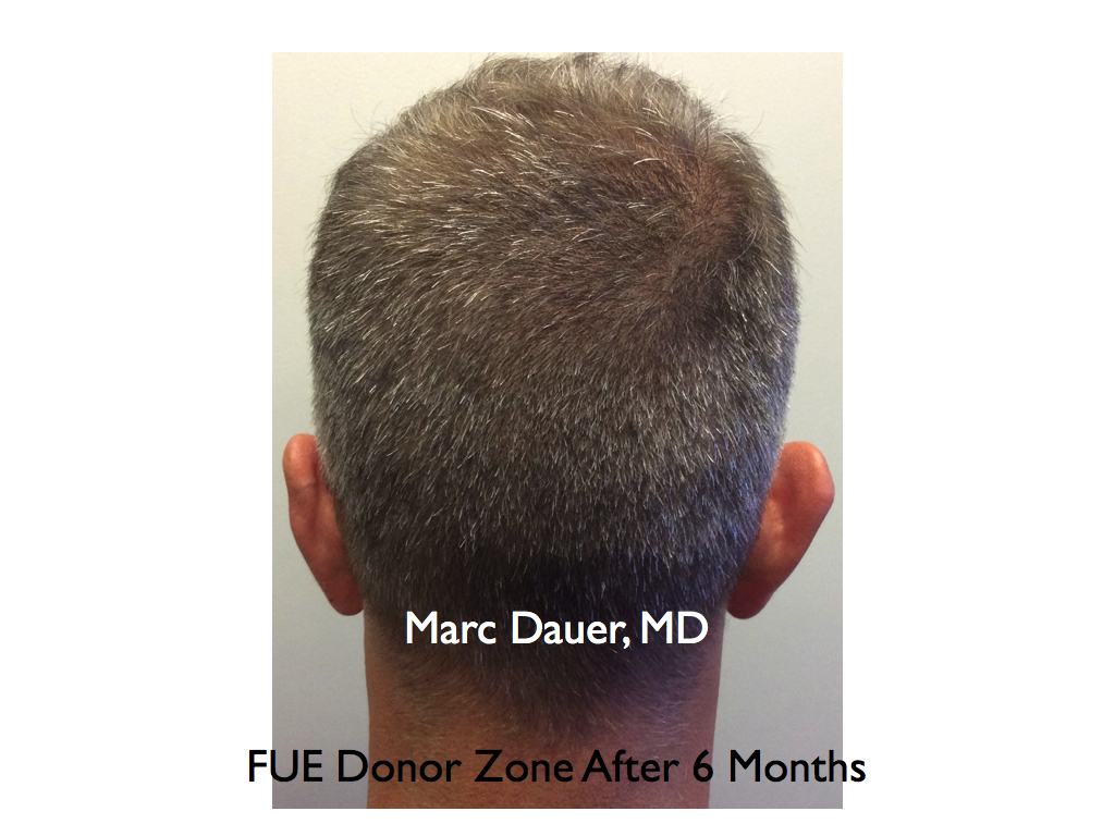 This is a photo of one of my FUE patients 6 months after harvesting just over 1600 grafts with a 0.9mm punch tool.