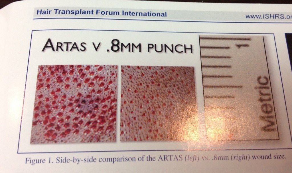 This is a photo from the latest edition of the ISHRS magazine showing the difference between the holes from the ARTAS and a manual .8mm FUE punch.