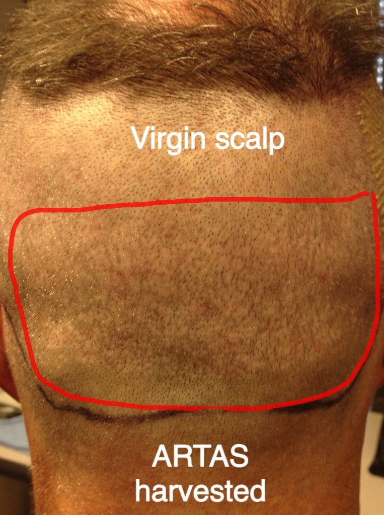 This is a patient who had a small number of FUE grafts harvested via the ARTAS one time. The scarring is very evident.