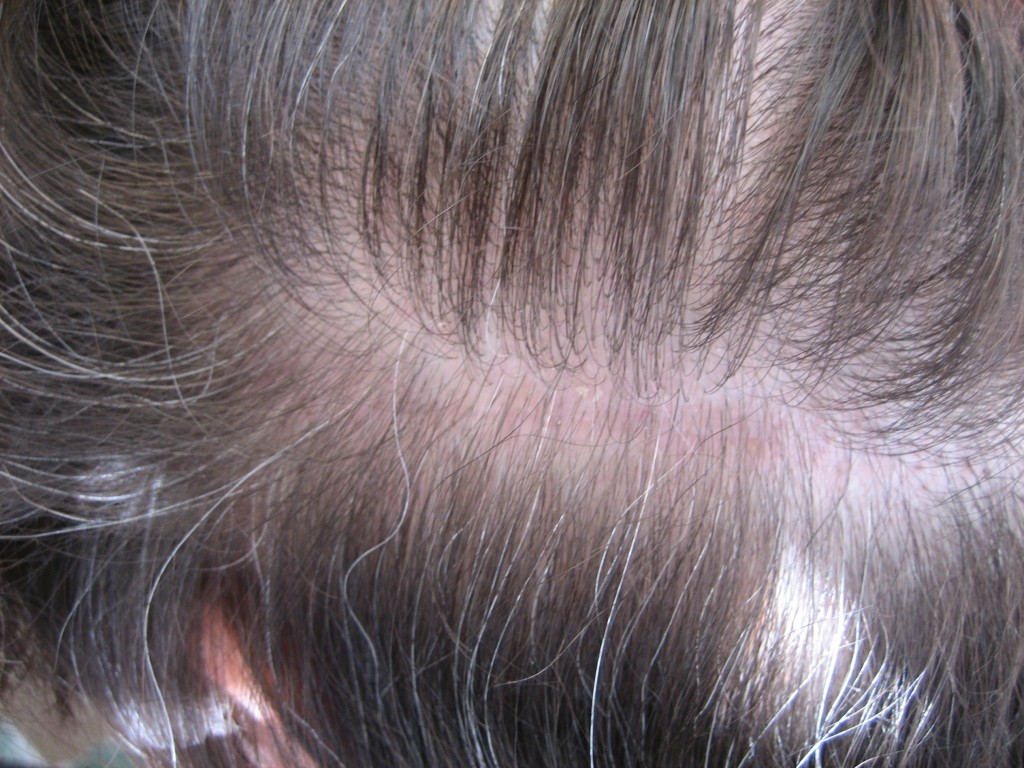 Hair transplant strip scar with trichophytic closure.