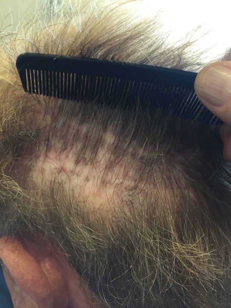 This is a photo of a patient who had multiple strip hair transplant procedures.