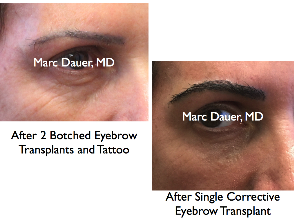 this is a botched eyebrow transplant repaired by Dr. Marc Dauer