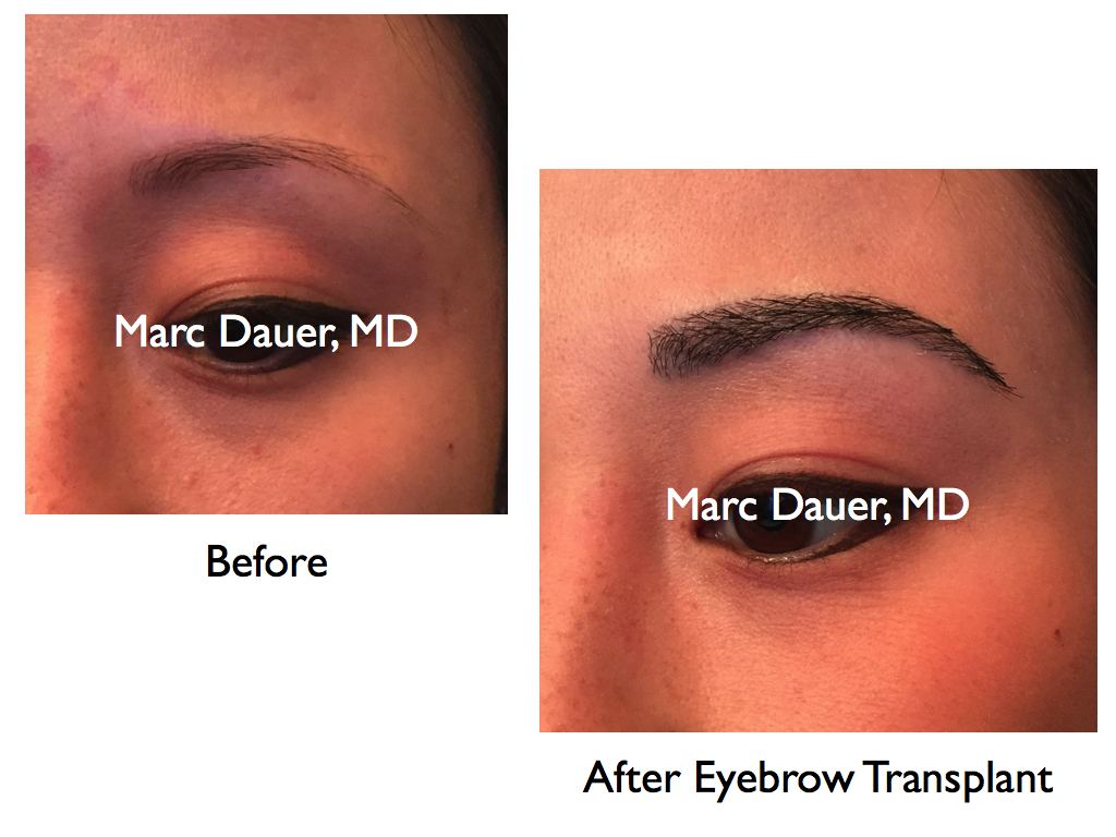 before and after photos of eyebrow transplant