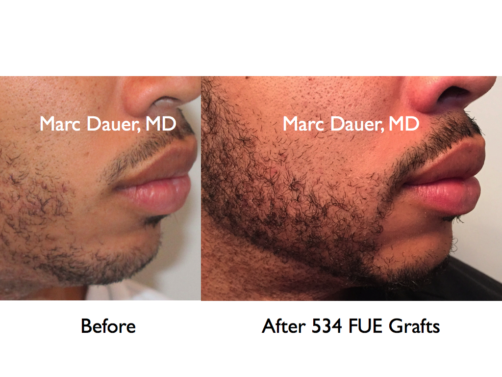 Beard Hair Transplant via FUE