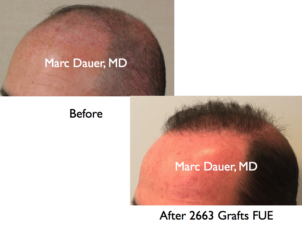 FUE hair transplant photo in a norwood 6 patient