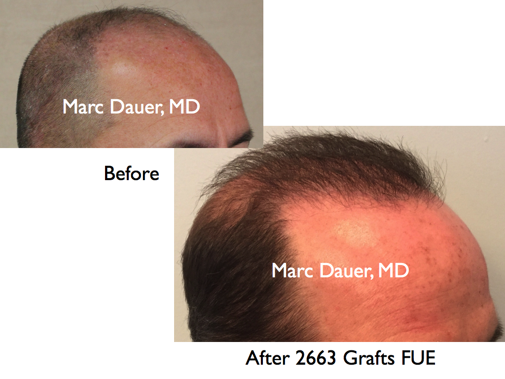 FUE hair transplant photo in a norwood 6 patient