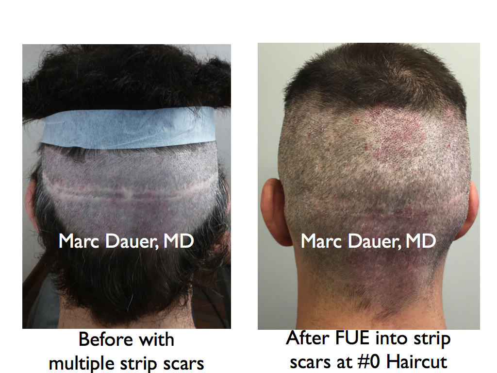 This is a patient with hair transplant strip scars who had FUE grafts placed into the scars.
