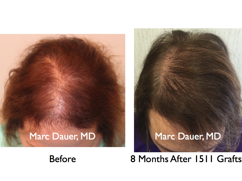 this is a female patient who received just over 1500 grafts with a FUT hair transplant procedure