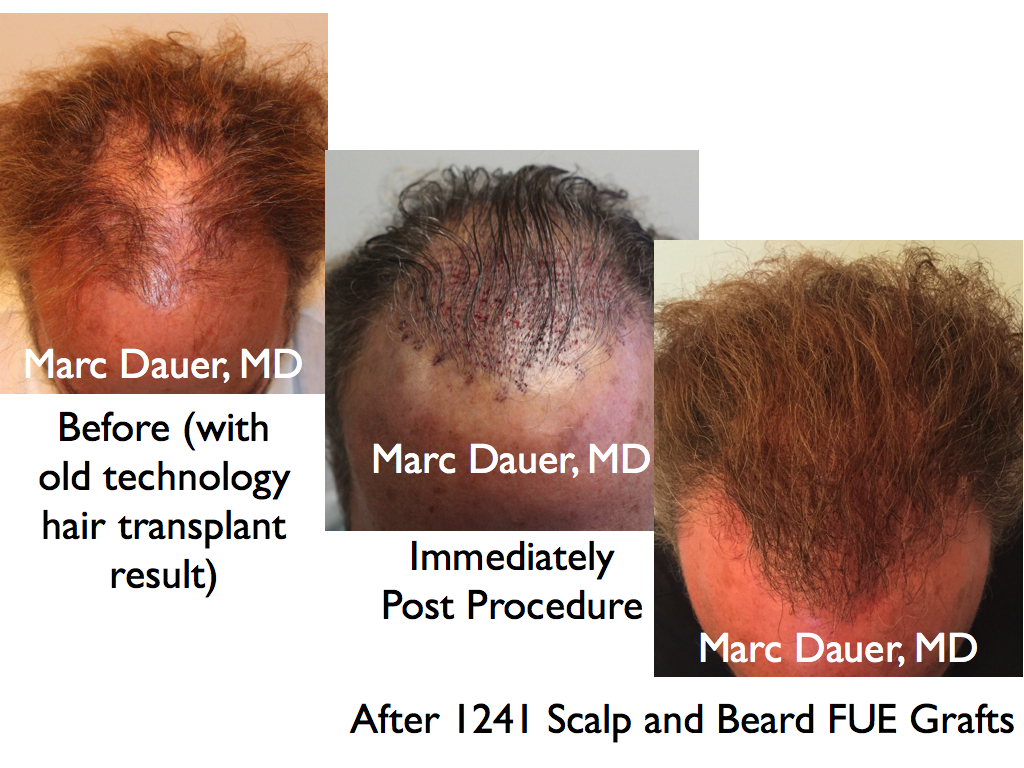 This is a patient who had beard hair harvested via FUE for placement in the scalp.