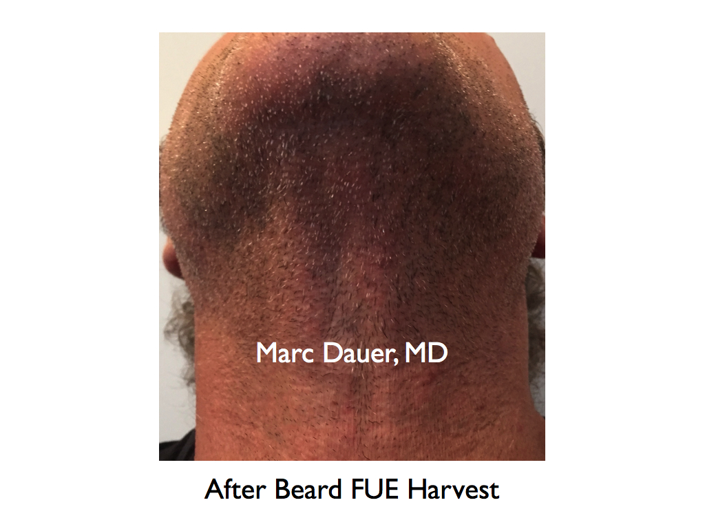 This is a patient who had beard hair harvested via FUE for placement in the scalp.