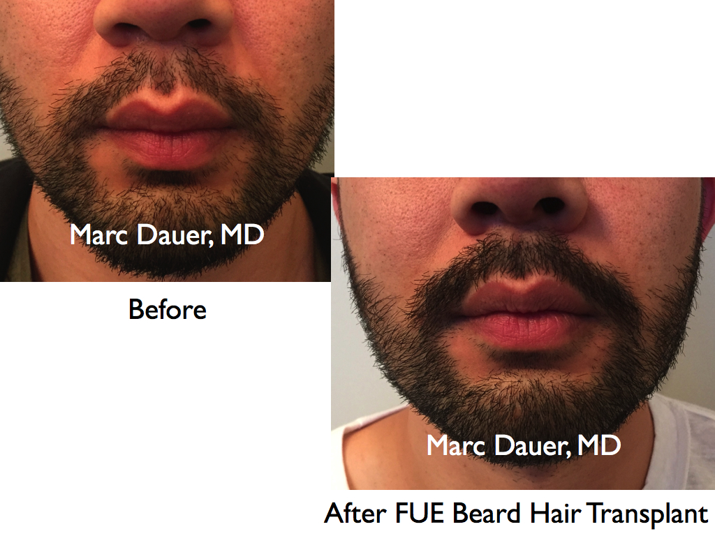 Beard FUE Hair Transplant