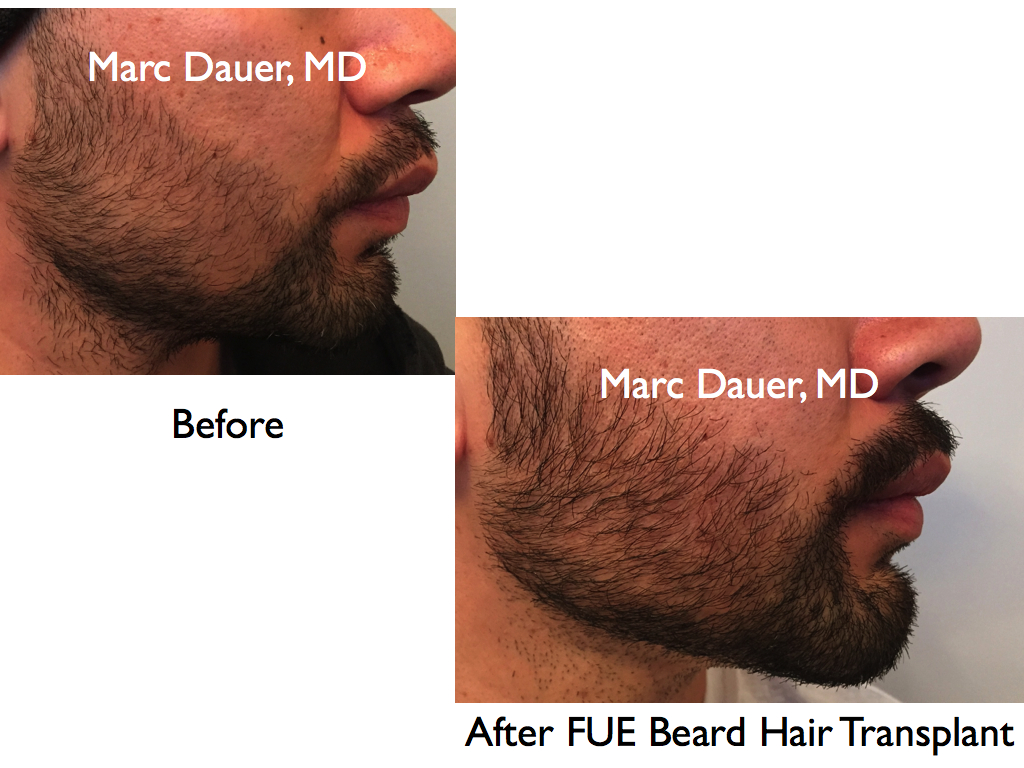Beard FUE Hair Transplant
