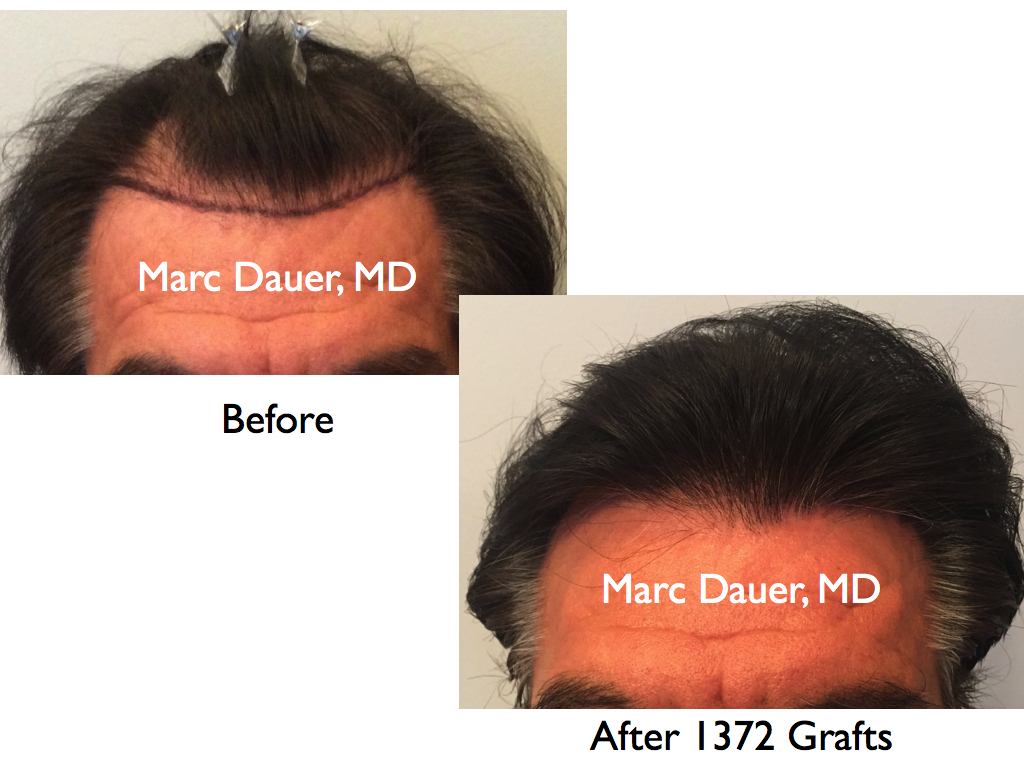 Hair Transplant To The Hairline