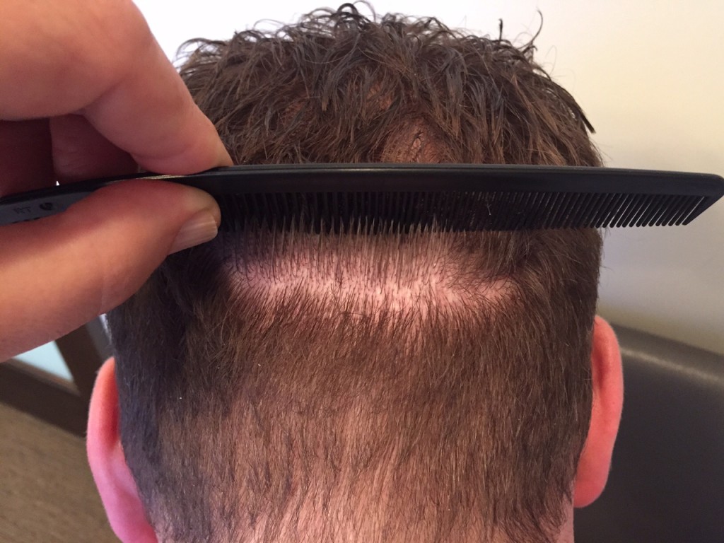 This is one of my patients who had a strip hair transplant procedure and his strip scar.